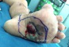 Khối loét sùi bàn chân trái