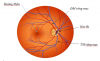 Tắc động mạch trung tâm võng mạc