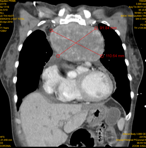 Hình ảnh khối u lớn được chụp lại. Ảnh: BV cung cấp.
