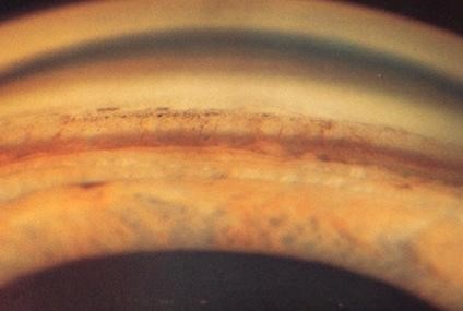 Hình ảnh soi góc bình thường