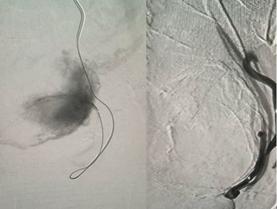 Chị H được điều trị UXTC bằng kỹ thuật can thiệp mạch (nút mạch)