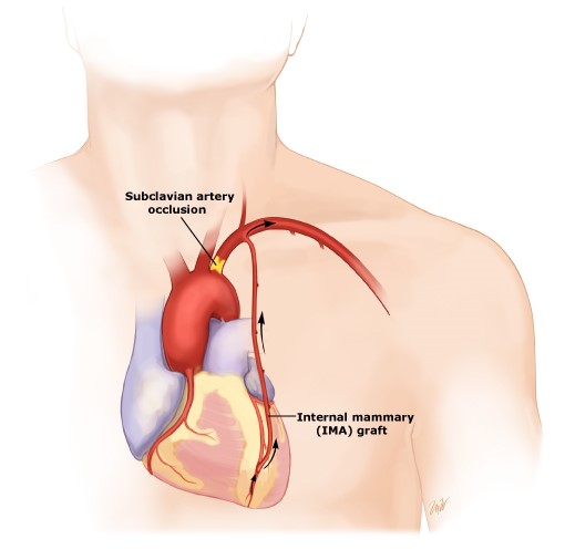 Cướp máu động mạch vành