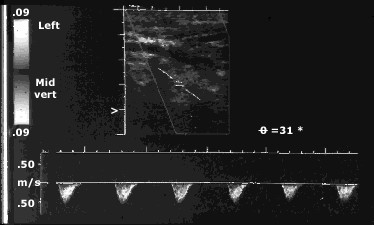 Doppler xuyên sọ
