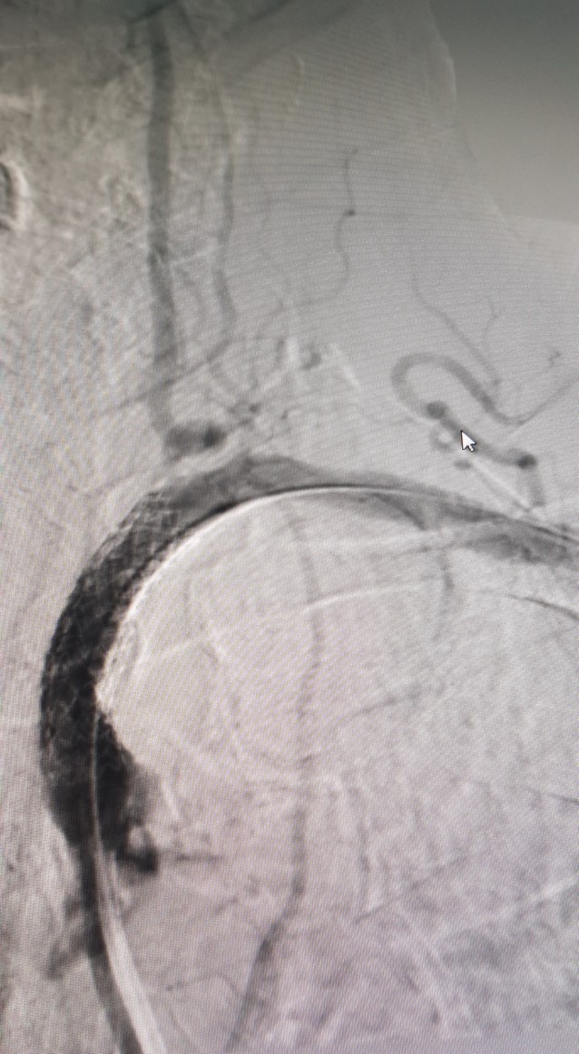 Hình ảnh can thiệp động mạch dưới đòn tại Bệnh viện Đa khoa Tỉnh Quảng Trị