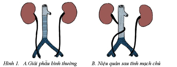 * Nguồn: theo Campbell-Walsh Urology (2012) [4] 