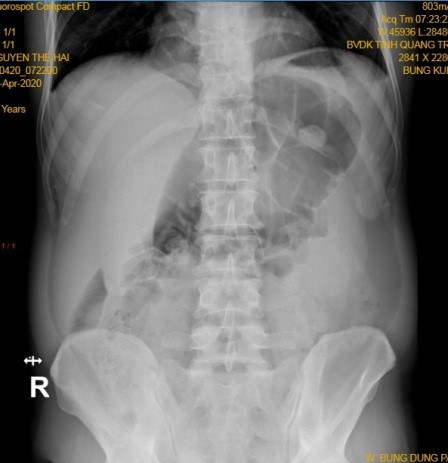 Xquang bung dung sang