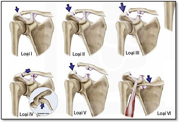Hình ảnh: Phân loại trật khớp cùng đòn theo Rockwood