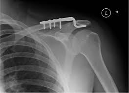 Hình ảnh kết hợp xương khớp cùng đòn bằng nẹp móc