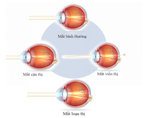 Hình ảnh: mô phỏng tật khúc xạ