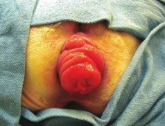 Hình 2 Sa niêm mạc trực tràng