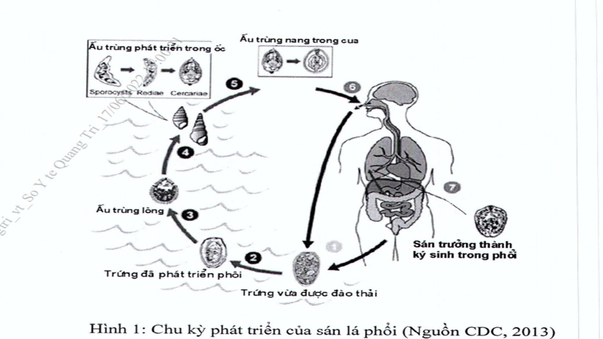 BỆNH SÁN LÁ PHỔI