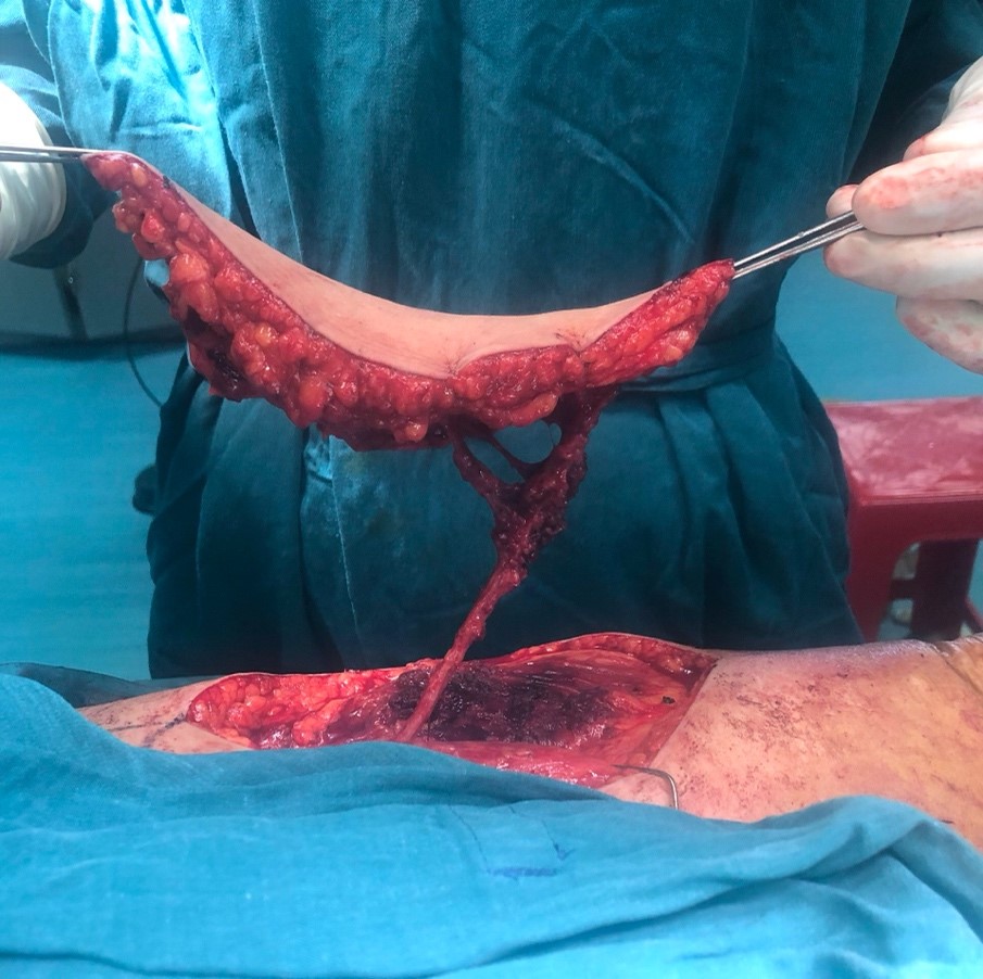 Vạt da sau khi phẫu tích kèm cuống mạch