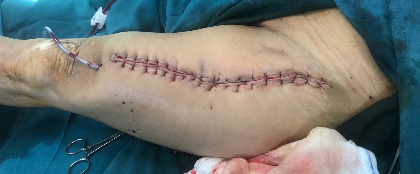 Vùng cho vạt được đóng kín thì đầu