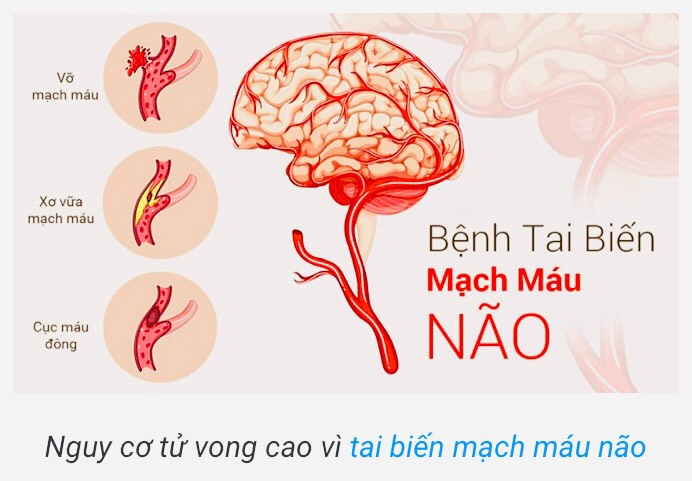 Nguy cơ tử vong vì tai biến mạch máu não