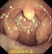 Hình ảnh 2 amidan quá phát