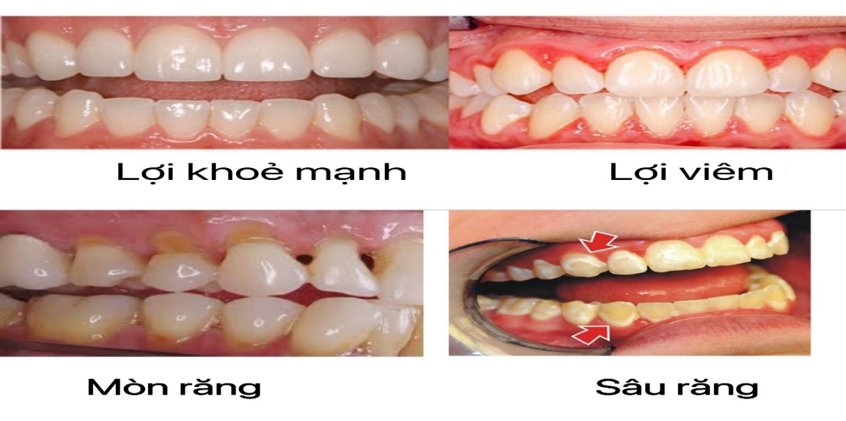Hướng dẫn cách chải răng đúng cách