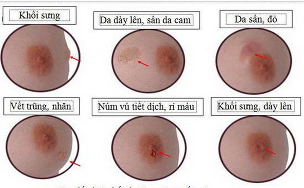 Dấu hiệu cảnh báo sớm bị ung thư vú