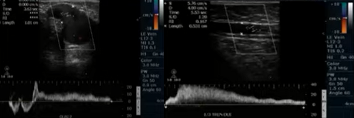 Bệnh lý suy tĩnh mạch chi dưới
