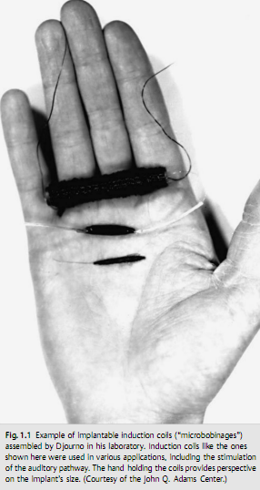 Hình.  Thiết bị kích thích thần kinh thính giác của Djourno và Eyries