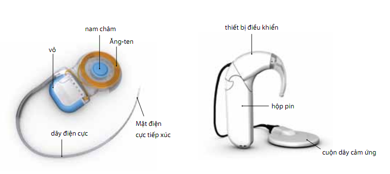 Hình. Hệ thống ốc tai điện tử thế hệ mới