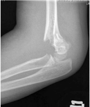 Hình 3:Gãy trên lồi cầu xương cánh tay Gartland độ IIB ,vỏxương phía sau còn nguyên vẹn kèm di lệch xoay ( Courtesy of Joshua M. Abzug, MD)