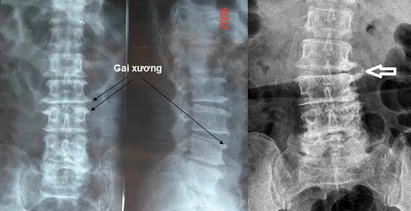 Bệnh thoái hóa cột sống thắt lưng