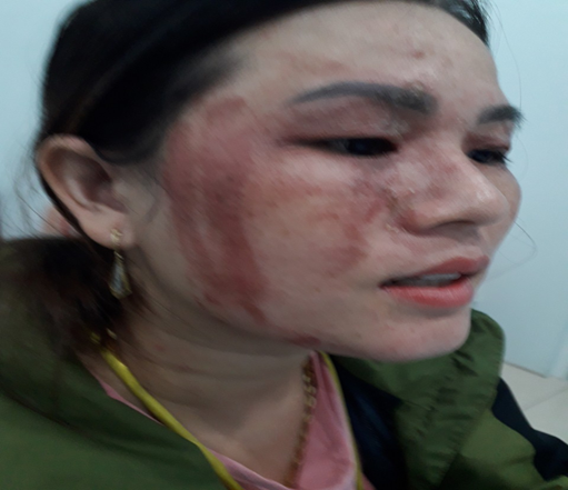 Viêm da tiếp xúc do kiến ba khoang