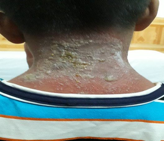 Viêm da tiếp xúc do kiến ba khoang