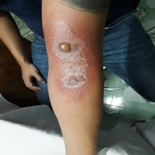 Viêm da tiếp xúc do kiến ba khoang