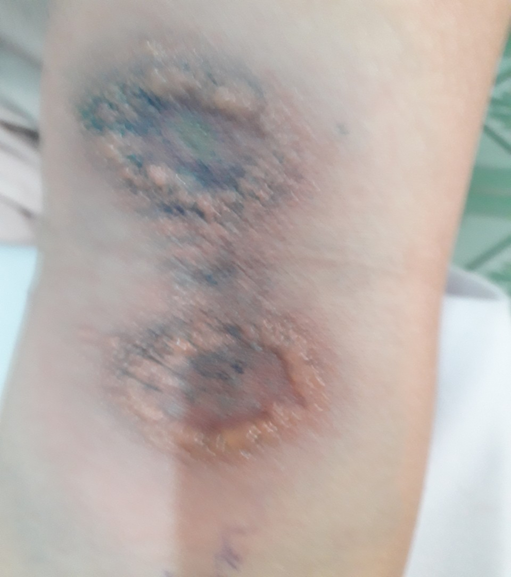 Viêm da tiếp xúc do kiến ba khoang