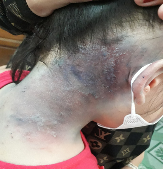 Viêm da tiếp xúc do kiến ba khoang