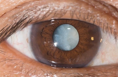 Hình 2. Đục TTT chín trắng