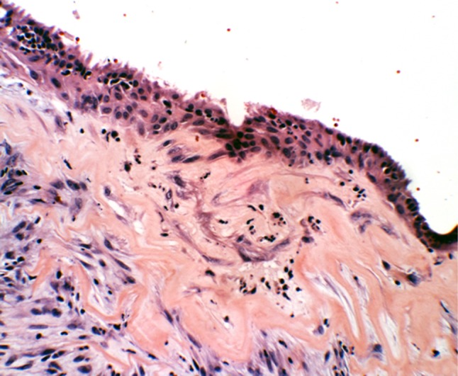 Viêm cấp, mạn tính và xơ hoá (Nguồn: Gregory G. Capra,  Peter N. Carbone, and David P. Mullin. Head Neck Pathol. 2012 Paranasal Sinus Mucocele )