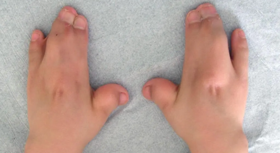 Hình 2: Dính ngón trong hội chứng Apert