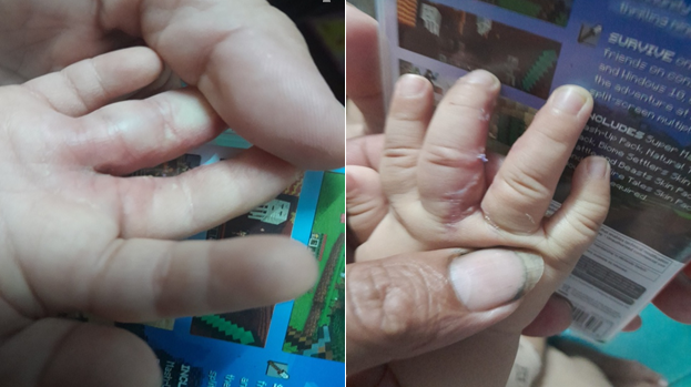 Hình 6: Sau phẫu thuật tách ngón 4 tuần