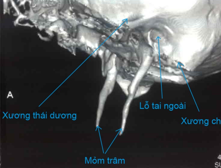 Hình ảnh dài mỏm trâm trên Ctscan.