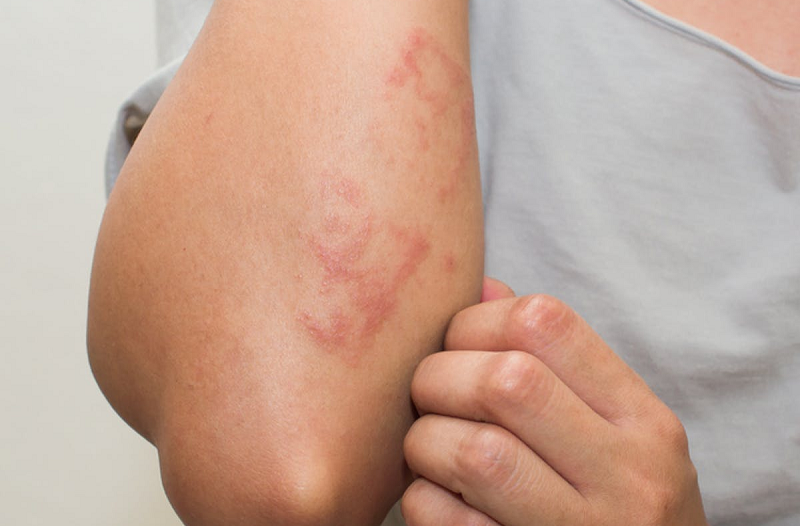 Hình 5: Ngứa da thường gặp ở bệnh thận mạn