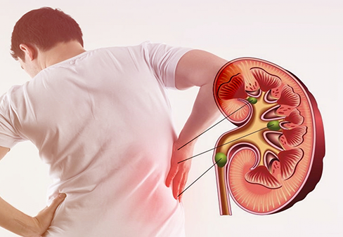 Hình 8: Đau lưng thường gợi ý do sỏi tiết niệu