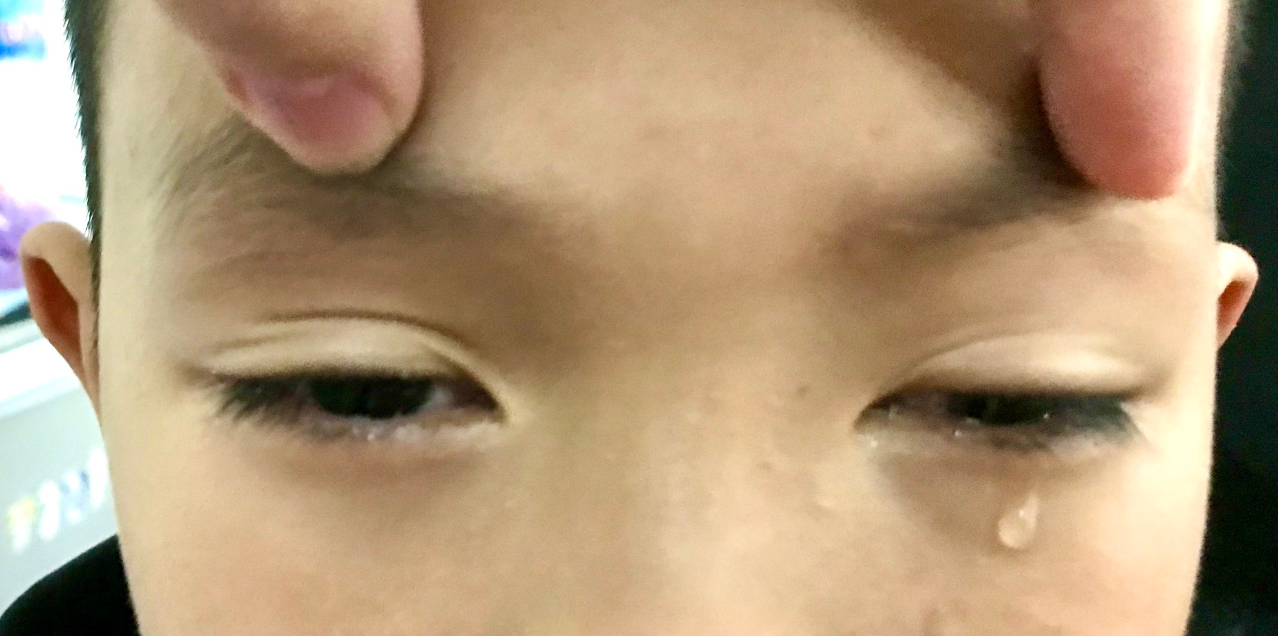 Vỡ thành hốc mắt