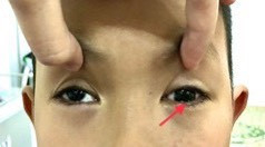 Vỡ thành hốc mắt