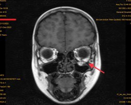 Vỡ thành hốc mắt