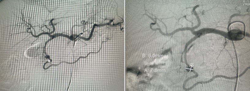 Hình 5 và 6. Chụp mạch trước can thiệp