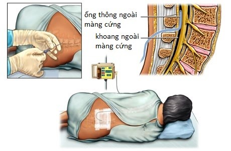 Hình ảnh minh họa: kỉ thuật giảm đau ngoài màng cứng