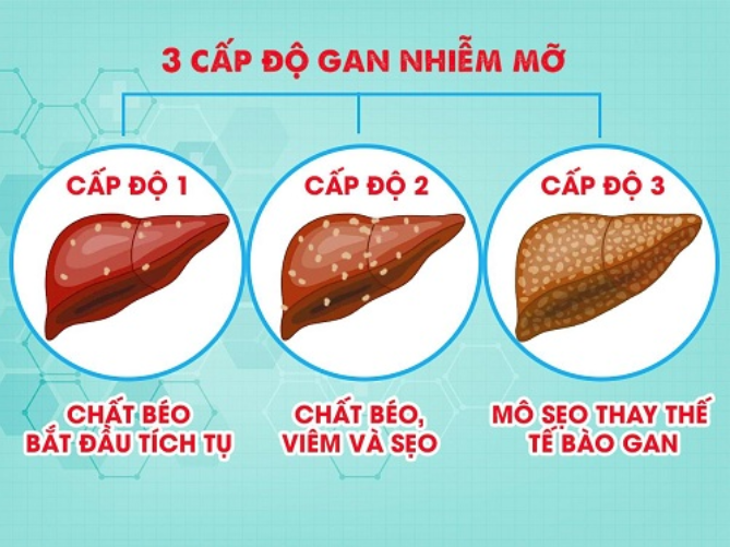 Hình 1. Phân độ gan nhiễm mỡ