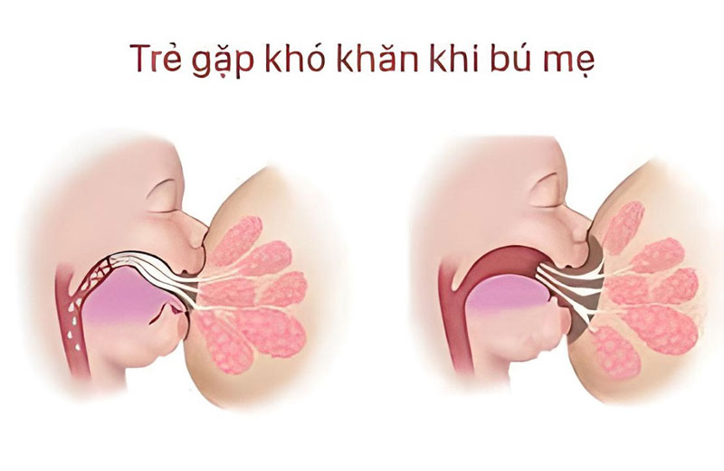 Trẻ nhỏ gặp trở ngại khi bú sữa nếu mắc bệnh dính thắng lưỡi