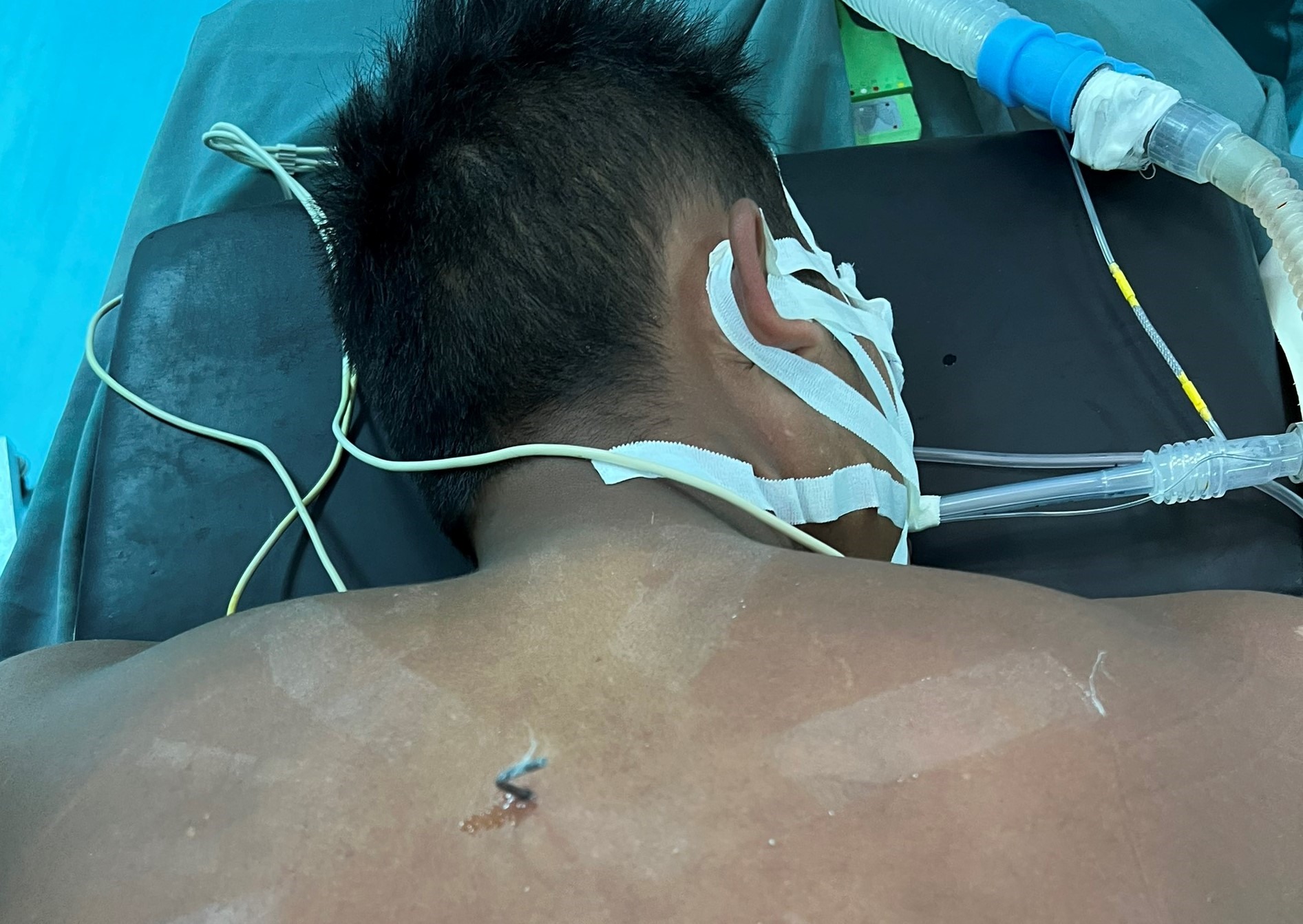 Mũi tên bắn cá bằng sắt xuyên vào tủy của bệnh nhân từ phía sau. Ảnh: A.Minh.
