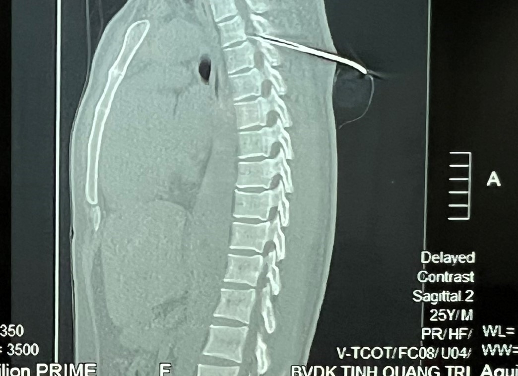 Hình ảnh cho thấy, phần mũi tên dài 7cm xuyên vào người bệnh nhân. Ảnh: A.Minh.