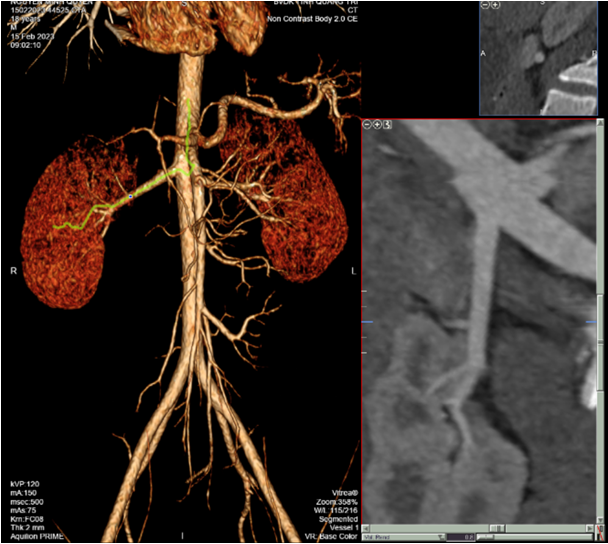 Hình ảnh chụp CT dựng hình và khảo sát mạch thận.