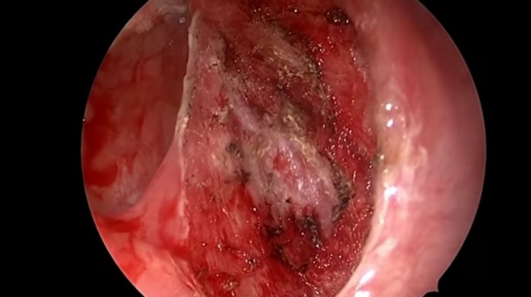  Hốc mổ sau cắt amidan bằng dao plasma