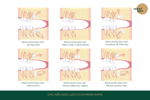 cac kieu moc rang khon 1